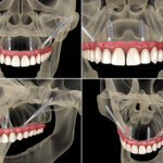 Zygoma Implants