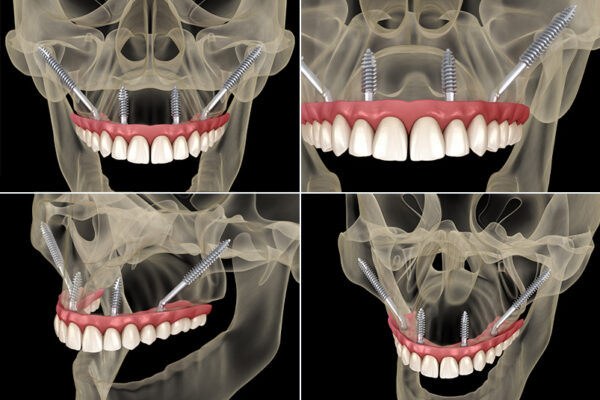 Zygoma Implants